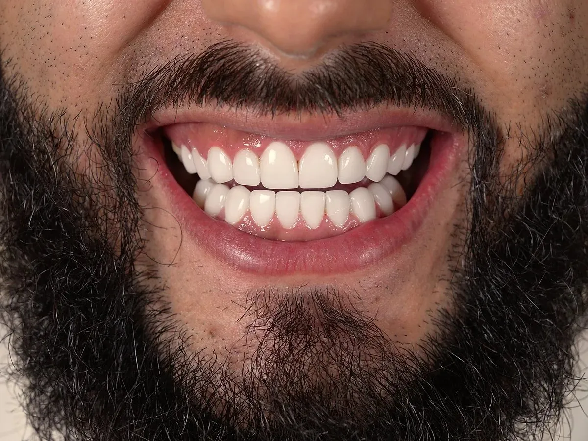 Sonrisa de un paciente de Smile Dental Center después de su tratamiento con carillas